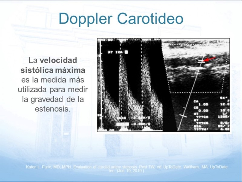 Diapositiva 15 de Estenosis Carotídea
