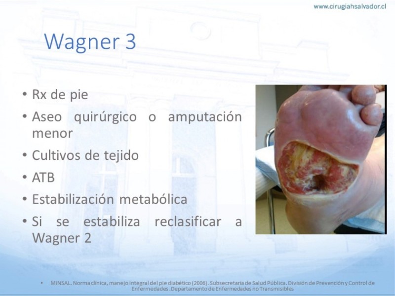 Diapositiva 27 de Manejo del Pie diabético