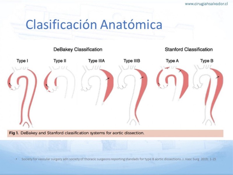 Diapositiva 9 de Síndrome Aórtico Agudo