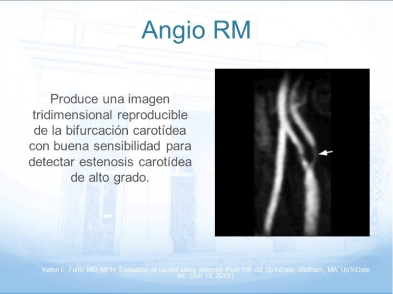 Diapositiva 18 de Estenosis Carotídea