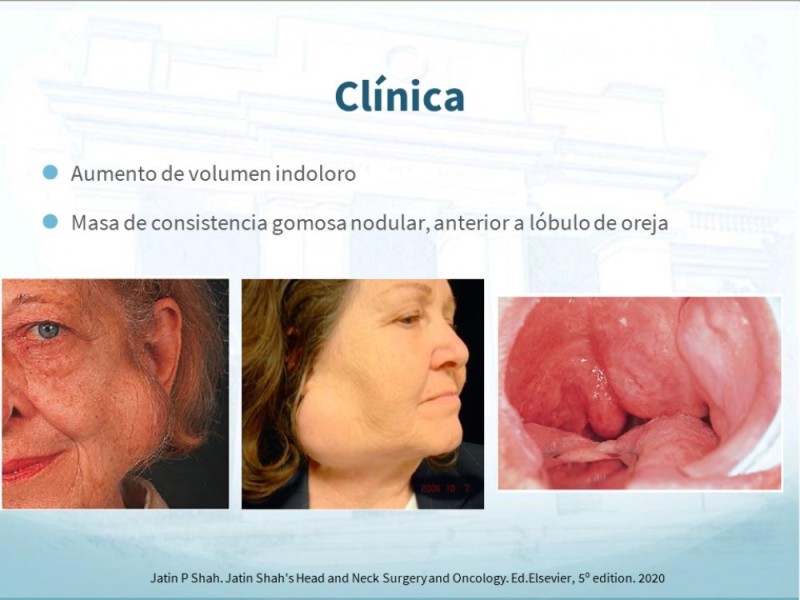 Diapositiva 7 de Tumores de Parótida
