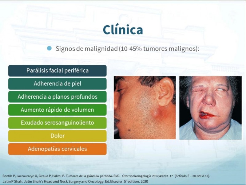 Diapositiva 8 de Tumores de Parótida