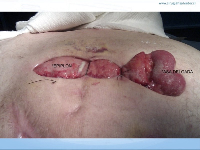 Diapositiva 11 de Manejo de la Evisceración