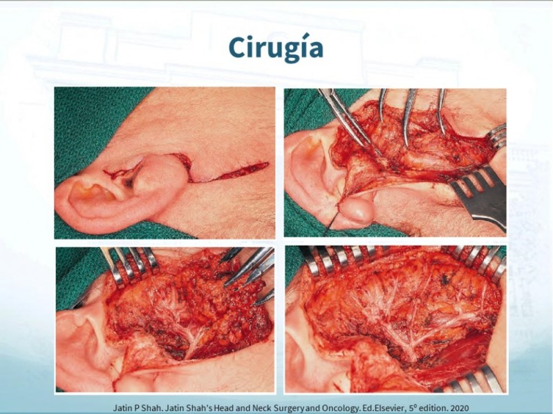 Diapositiva 23 de Tumores de Parótida