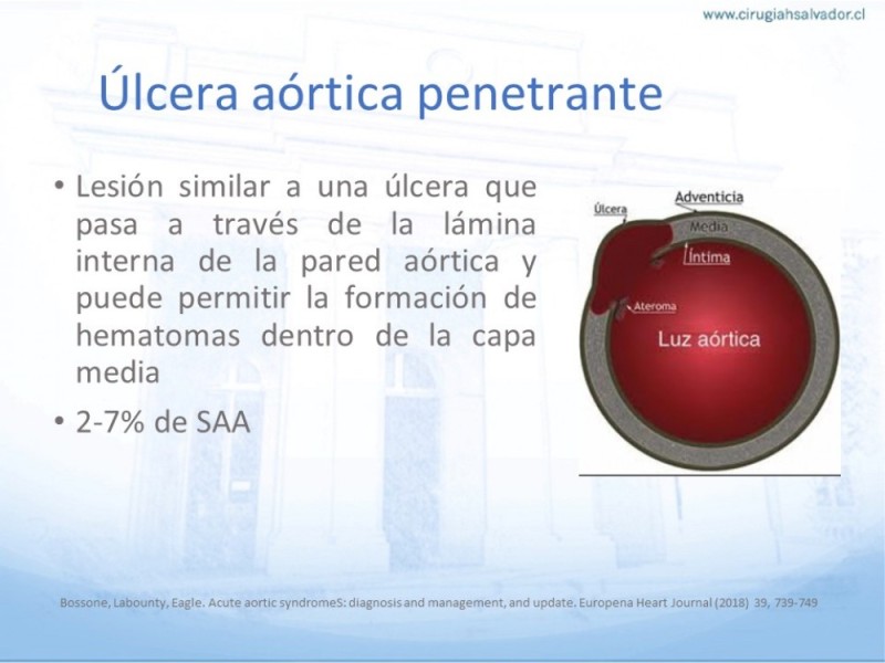 Diapositiva 3 de Síndrome Aórtico Agudo