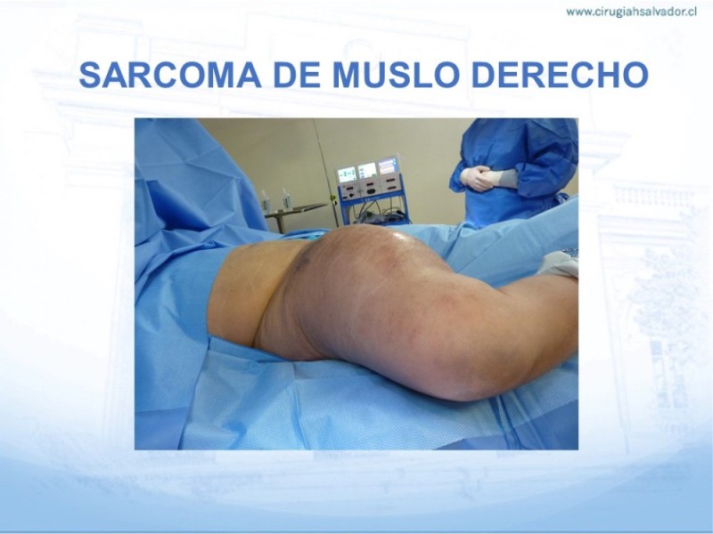 Diapositiva 18 de Sarcoma de partes blandas​