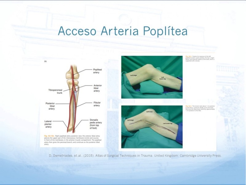 Diapositiva 24 de Manejo quirúrgico del pseudoaneurisma de extremidades
