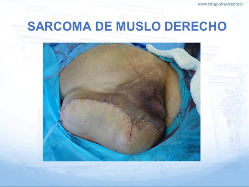 Diapositiva 20 de Sarcoma de partes blandas​