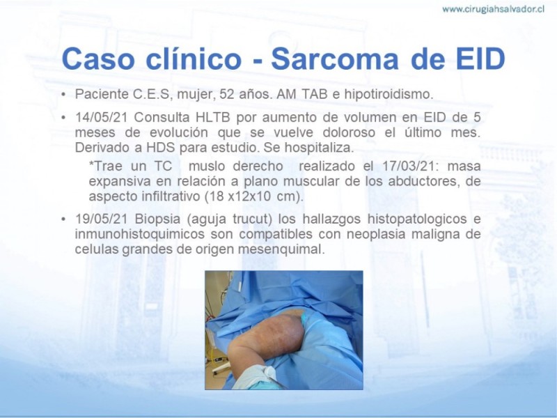 Diapositiva 15 de Sarcoma de partes blandas​