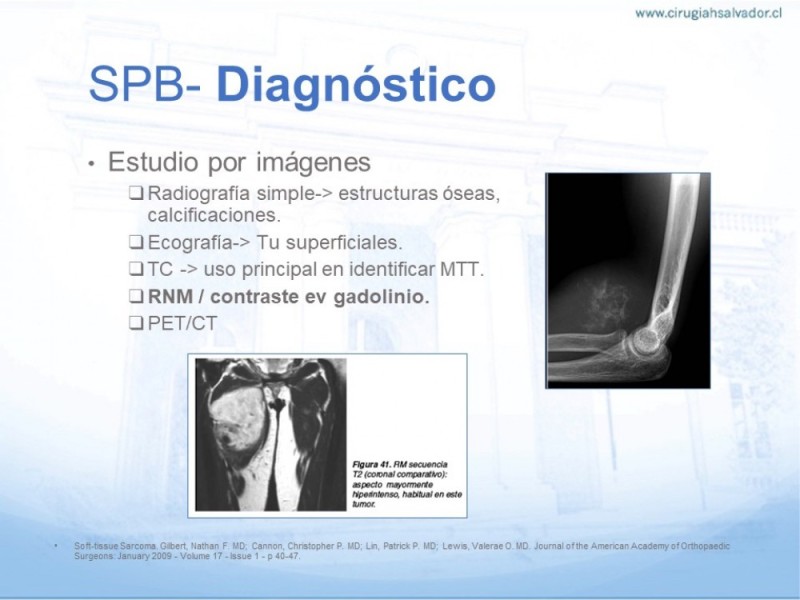 Diapositiva 6 de Sarcoma de partes blandas​