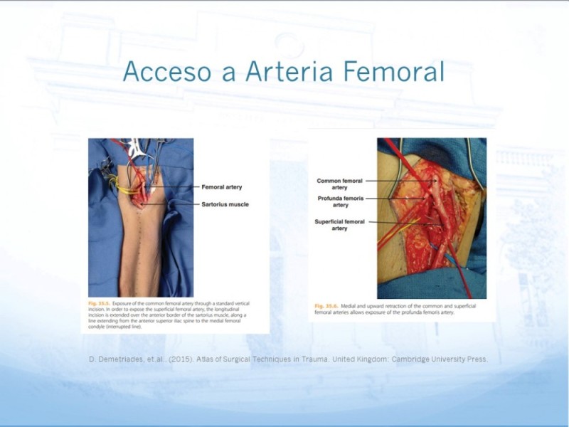 Diapositiva 23 de Manejo quirúrgico del pseudoaneurisma de extremidades