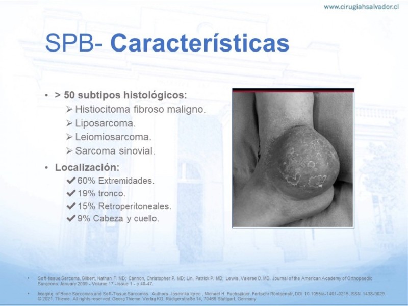 Diapositiva 3 de Sarcoma de partes blandas​