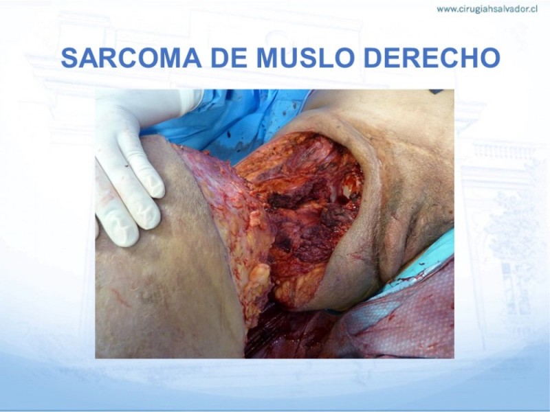 Diapositiva 19 de Sarcoma de partes blandas​