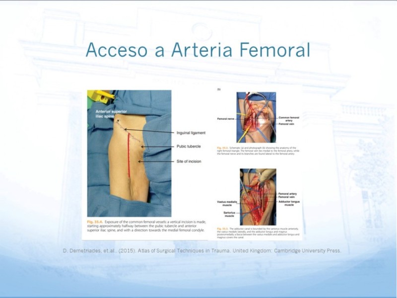 Diapositiva 22 de Manejo quirúrgico del pseudoaneurisma de extremidades