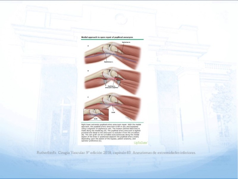 Diapositiva 25 de Manejo quirúrgico del pseudoaneurisma de extremidades