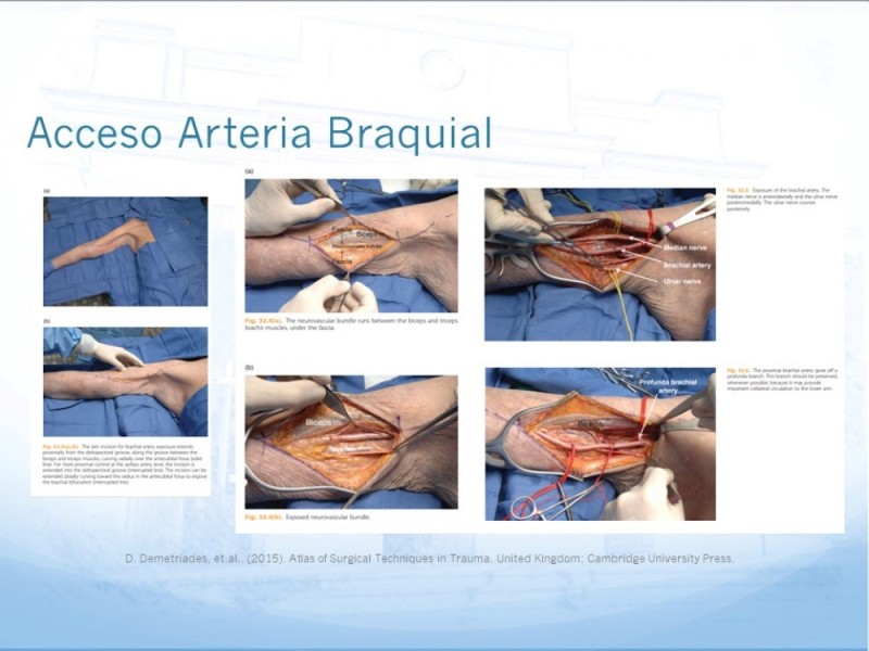 Diapositiva 21 de Manejo quirúrgico del pseudoaneurisma de extremidades