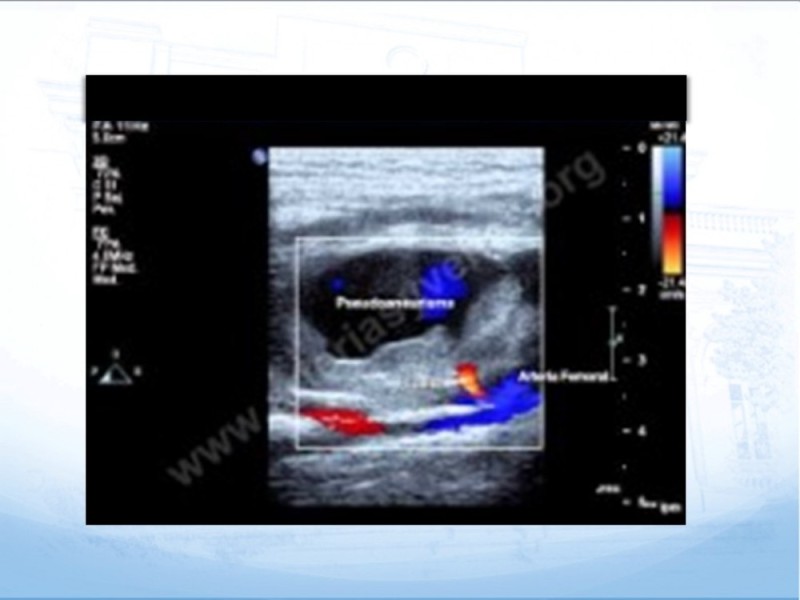 Diapositiva 10 de Manejo quirúrgico del pseudoaneurisma de extremidades