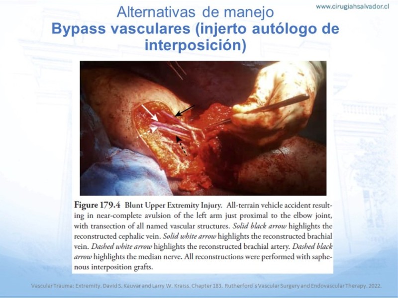 Diapositiva 15 de Trauma Vascular en Extremidad Severamente Lesionada Técnicas de reparación