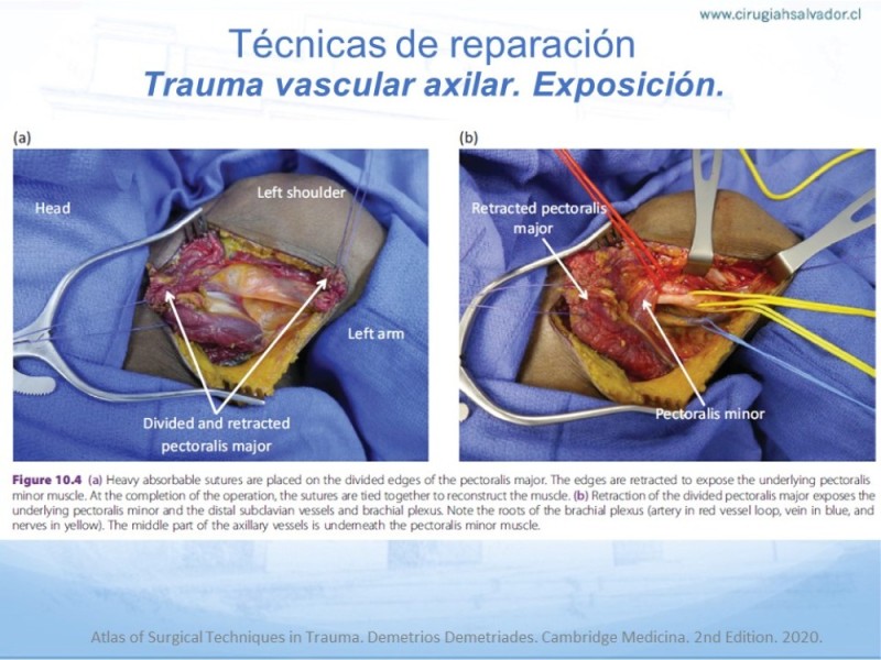 Diapositiva 21 de Trauma Vascular en Extremidad Severamente Lesionada Técnicas de reparación