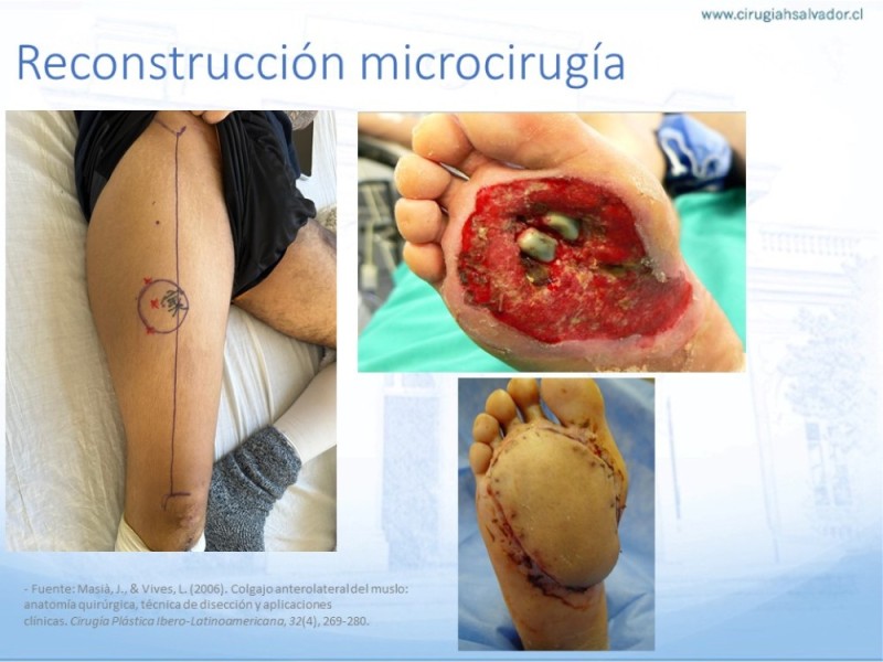 Diapositiva 47 de Reconstrucción miembro inferior