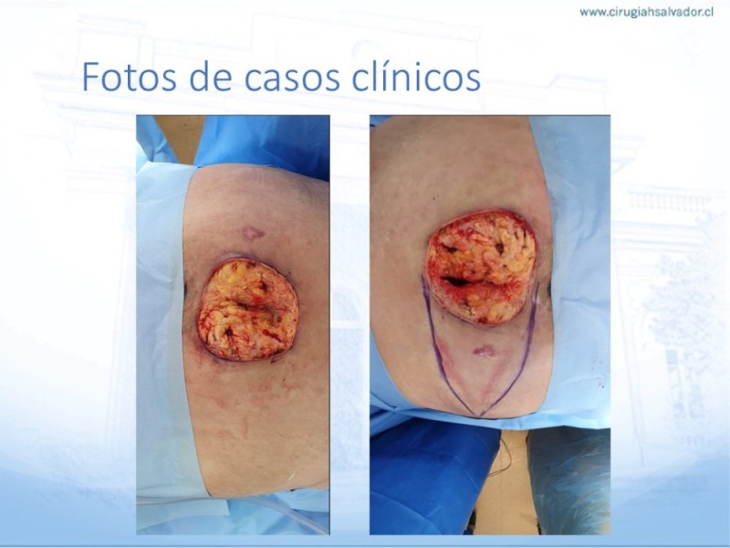 Diapositiva 33 de Lesiones por presión