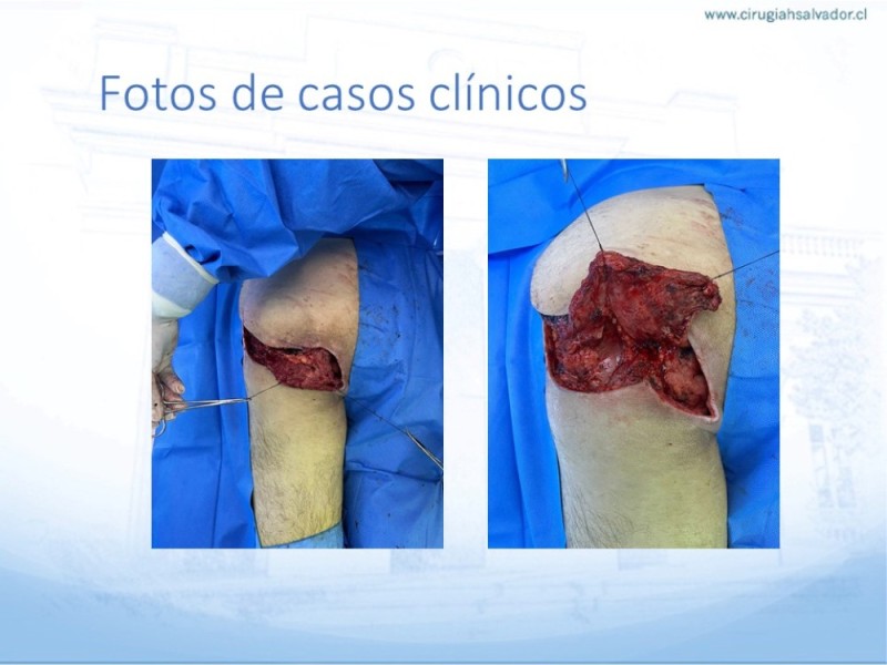 Diapositiva 44 de Lesiones por presión