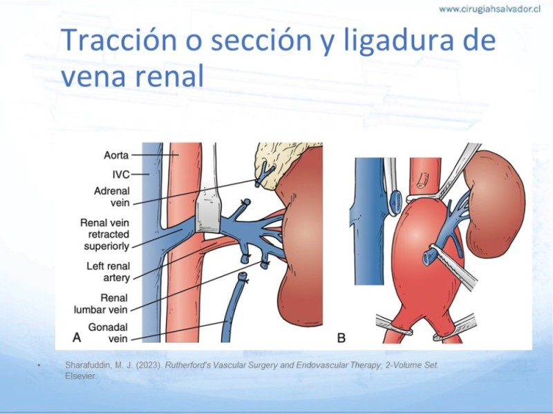 Diapositiva 19 de Aneurisma Aorta Abdominal: Abordaje infrarrenal - clamp supracelíaco