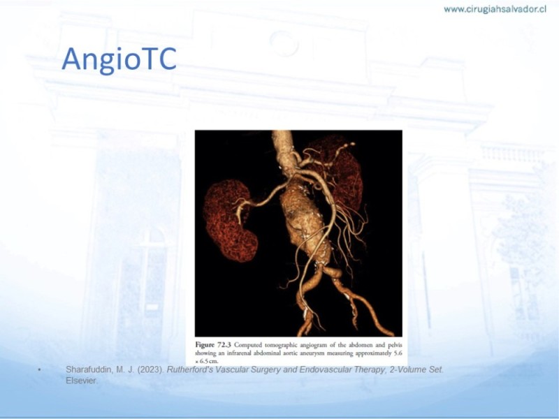 Diapositiva 10 de Aneurisma Aorta Abdominal: Abordaje infrarrenal - clamp supracelíaco