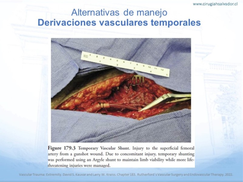 Diapositiva 18 de Trauma Vascular en Extremidad Severamente Lesionada Técnicas de reparación