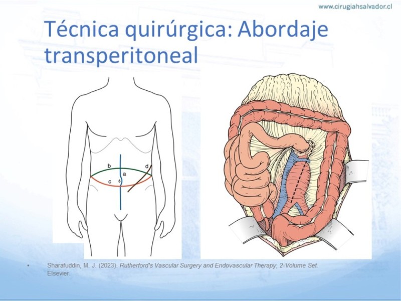 Diapositiva 17 de Aneurisma Aorta Abdominal: Abordaje infrarrenal - clamp supracelíaco