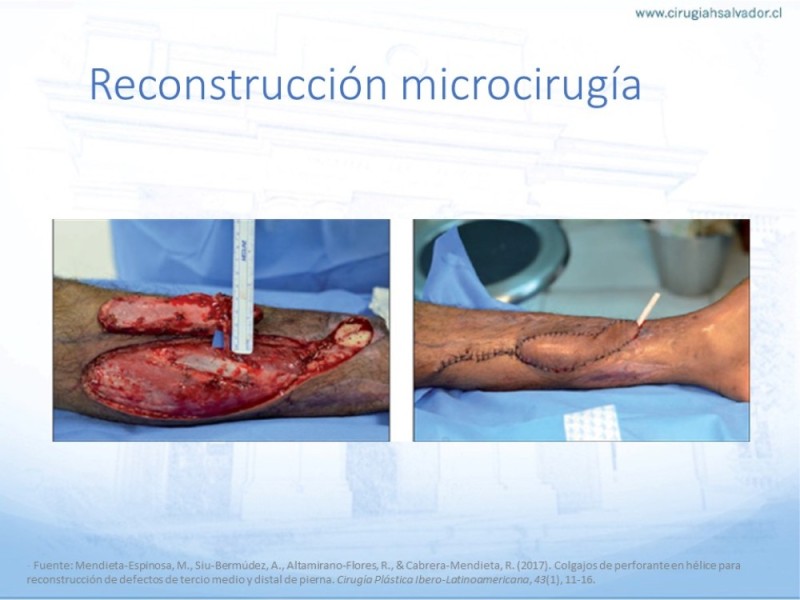 Diapositiva 46 de Reconstrucción miembro inferior