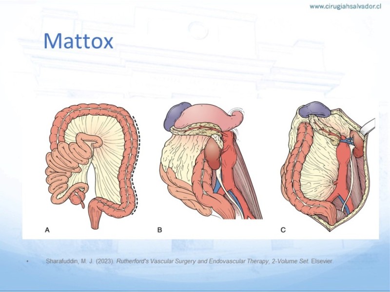 Diapositiva 27 de Aneurisma Aorta Abdominal: Abordaje infrarrenal - clamp supracelíaco