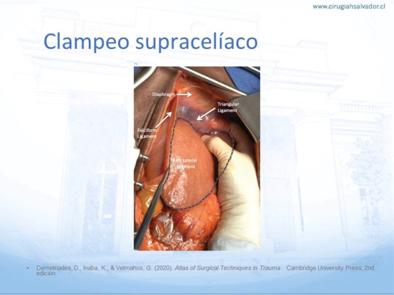 Diapositiva 21 de Aneurisma Aorta Abdominal: Abordaje infrarrenal - clamp supracelíaco