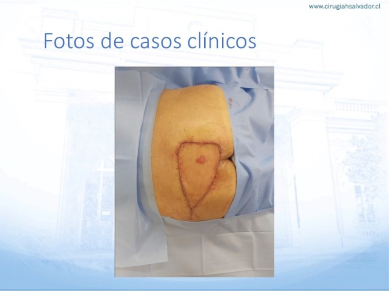 Diapositiva 34 de Lesiones por presión