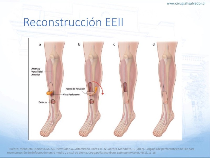 Diapositiva 45 de Reconstrucción miembro inferior
