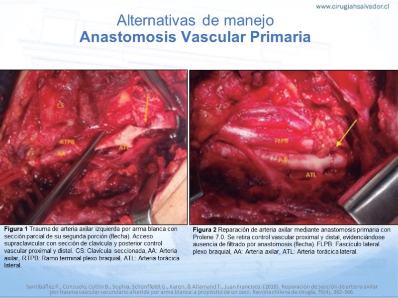 Diapositiva 12 de Trauma Vascular en Extremidad Severamente Lesionada Técnicas de reparación