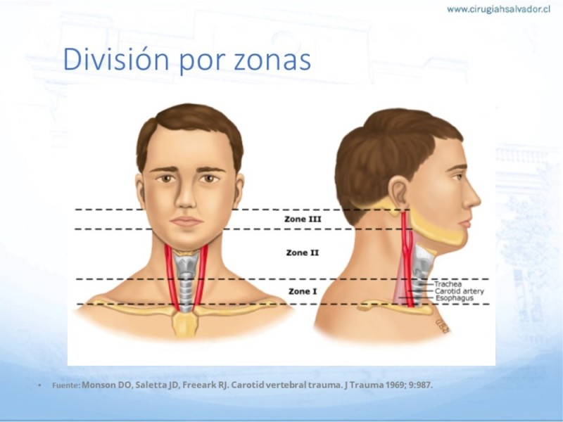 Diapositiva 4 de Trauma vascular cervical