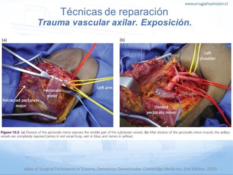Diapositiva 22 de Trauma Vascular en Extremidad Severamente Lesionada Técnicas de reparación