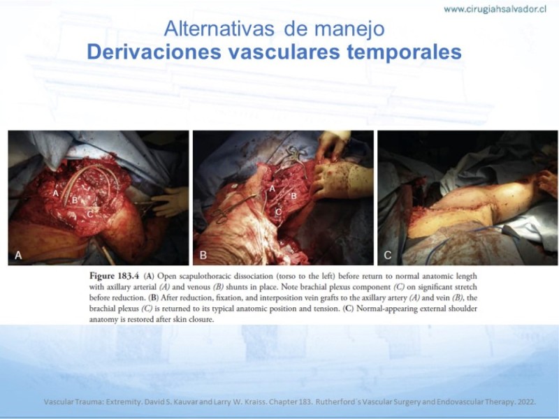 Diapositiva 17 de Trauma Vascular en Extremidad Severamente Lesionada Técnicas de reparación