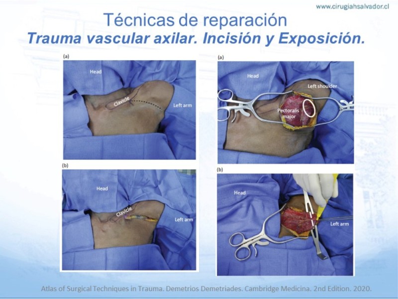 Diapositiva 20 de Trauma Vascular en Extremidad Severamente Lesionada Técnicas de reparación