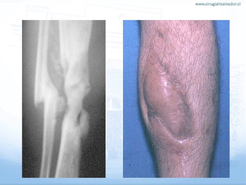 Diapositiva 36 de Reconstrucción miembro inferior