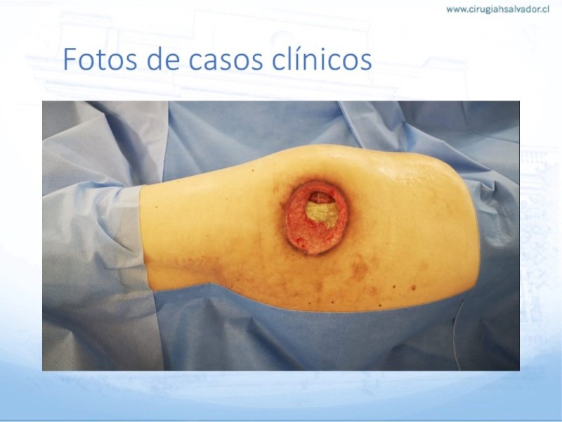 Diapositiva 39 de Lesiones por presión
