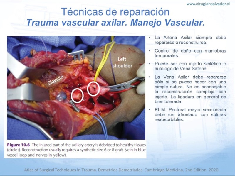 Diapositiva 23 de Trauma Vascular en Extremidad Severamente Lesionada Técnicas de reparación