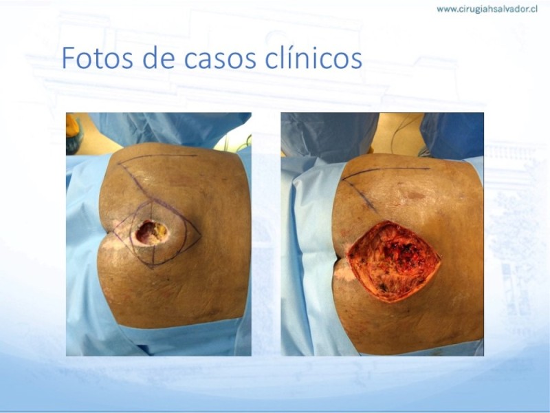 Diapositiva 37 de Lesiones por presión