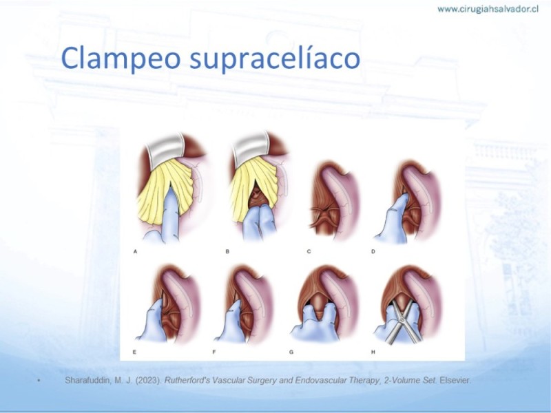 Diapositiva 20 de Aneurisma Aorta Abdominal: Abordaje infrarrenal - clamp supracelíaco