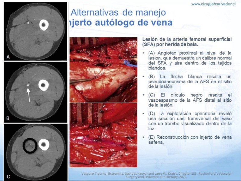 Diapositiva 13 de Trauma Vascular en Extremidad Severamente Lesionada Técnicas de reparación