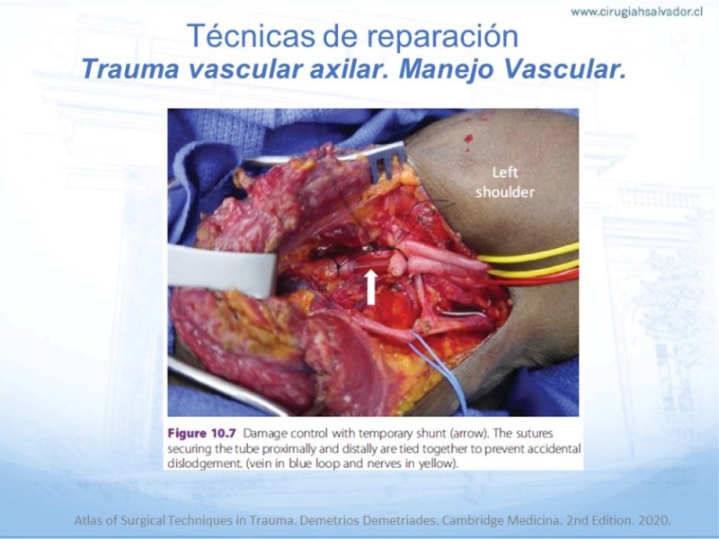 Diapositiva 24 de Trauma Vascular en Extremidad Severamente Lesionada Técnicas de reparación