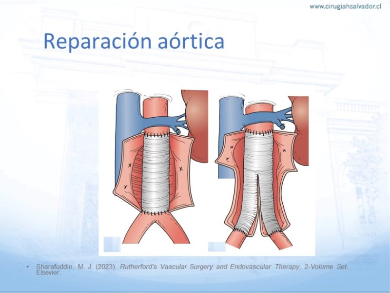 Diapositiva 29 de Aneurisma Aorta Abdominal: Abordaje infrarrenal - clamp supracelíaco