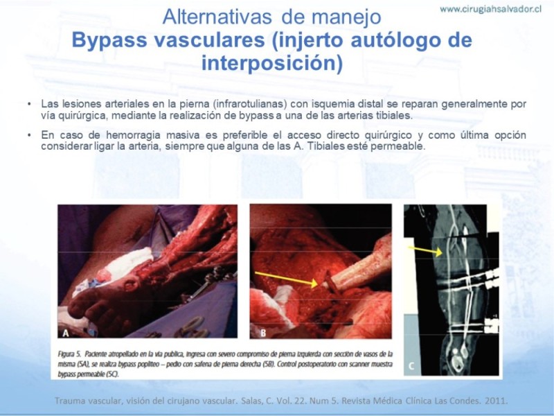 Diapositiva 14 de Trauma Vascular en Extremidad Severamente Lesionada Técnicas de reparación