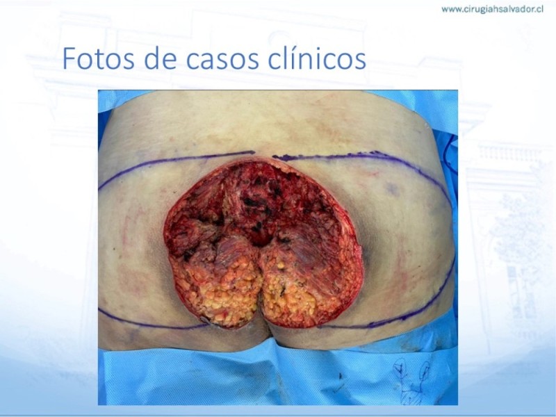 Diapositiva 35 de Lesiones por presión